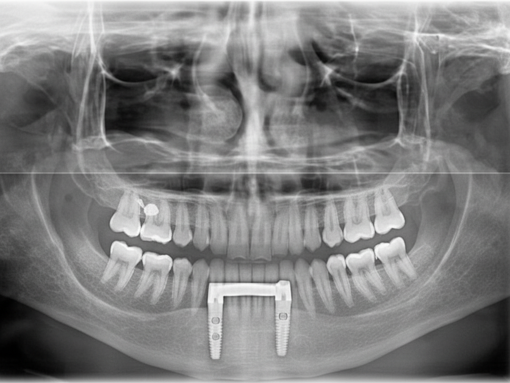 İmmediat Yükleme Protokollerinde Klinik Başarı Kriterleri
